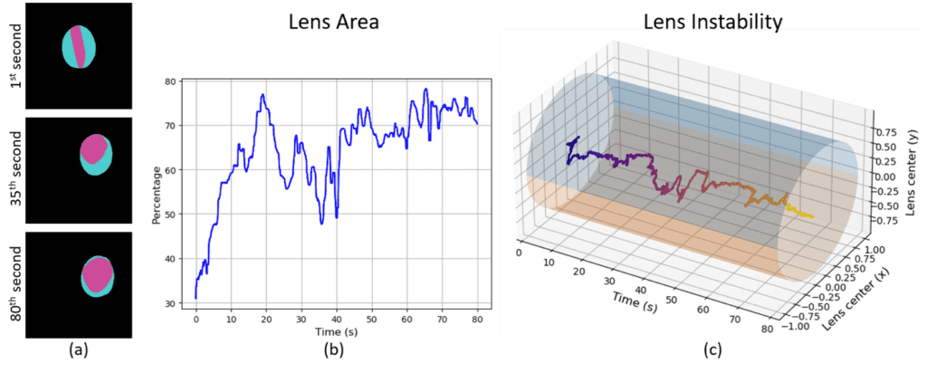 Darstellung einer Deep-learning-assisted intraocular lens irregularity detection während einer Katarakt-Operation